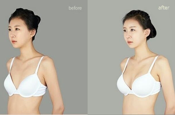 antes e despois do aumento de peito plástico