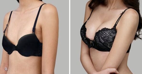 antes e despois do aumento mamario