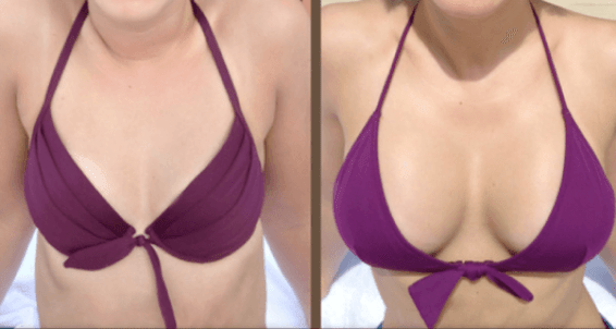 Antes e despois da cirurxía de aumento de mama