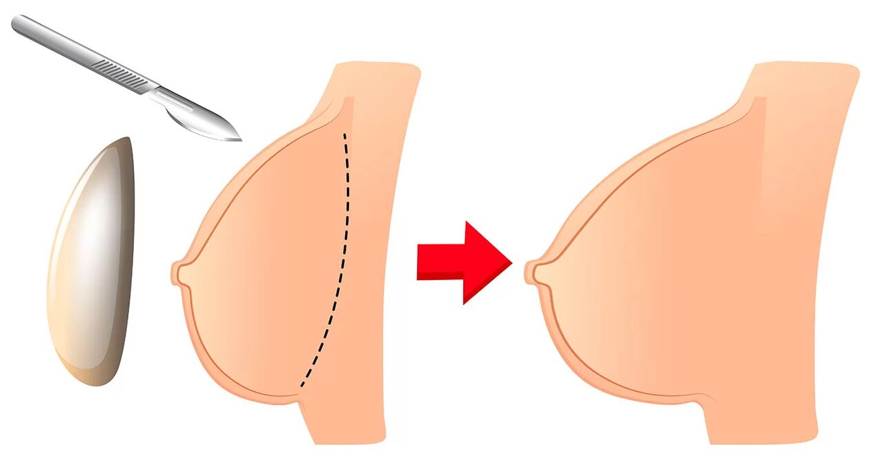 Aumento de mama cun implante