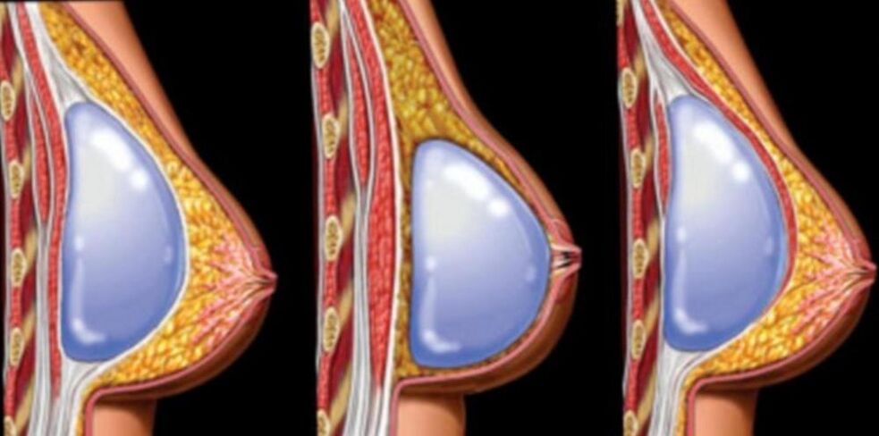 Instalación de implantes