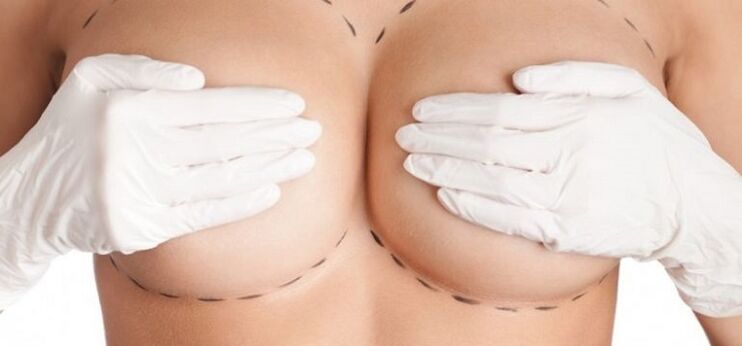 Aumento de mama mediante cirurxía